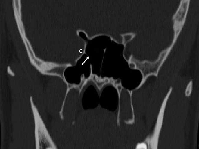 CT of sphenoid sinus showing relationship to internal carotid artery