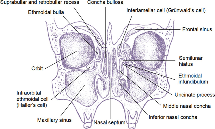 Ostiomeatal complex anatomy on coronal CT showing uncinate process and middle meatus