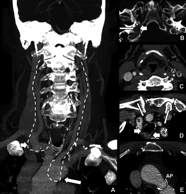 Course of the vagus nerve and recurrent laryngeal nerves in the neck and thorax