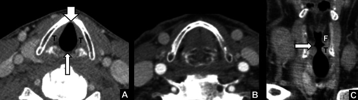 Laryngoscopy showing normal vocal fold appearance and vocal fold paralysis