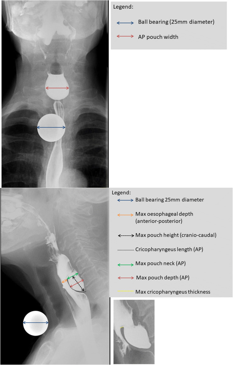 Barium swallow showing Zenker diverticulum as posterior pharyngeal outpouching