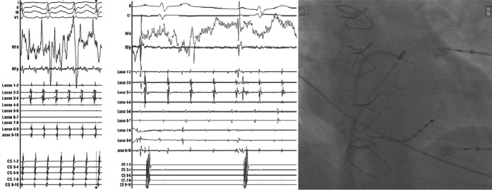 Atrial fibrillation triggers from pulmonary veins showing ectopic foci initiating AF
