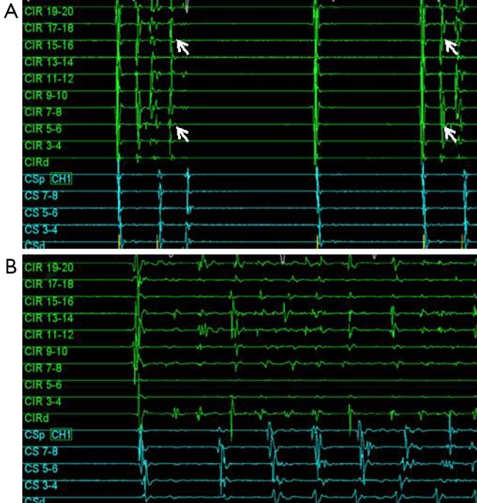 Pulmonary vein isolation AF ablation strategy showing wide area circumferential ablation lesion sets