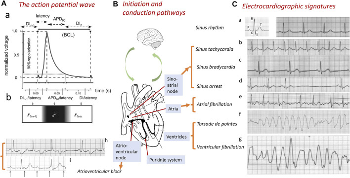 Three arrhythmia mechanisms: reentry, automaticity, and triggered activity with ion channel basis