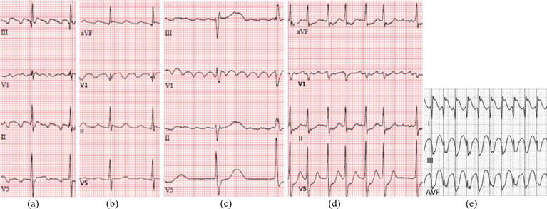 Atrial flutter macro-reentrant circuit around tricuspid valve with cavotricuspid isthmus as critical zone