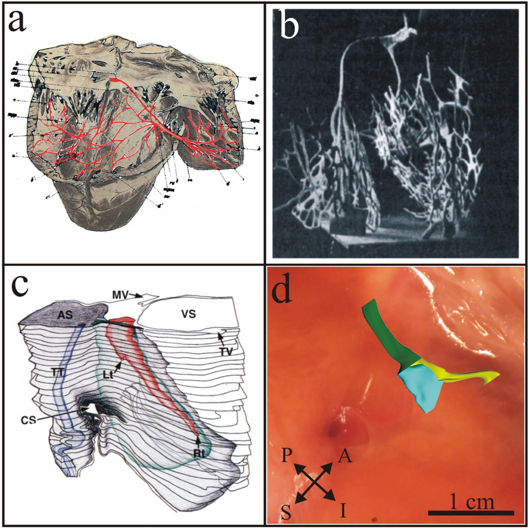 AV node anatomy and triangle of Koch showing electrophysiology catheter positions