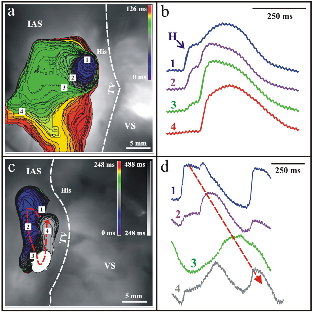 AVNRT reentry circuit with dual AV node pathways in the triangle of Koch
