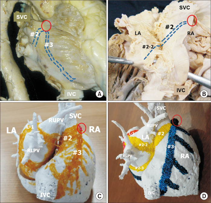 Intracardiac catheter positions in an electrophysiology study showing HRA, His, CS, and RV catheters