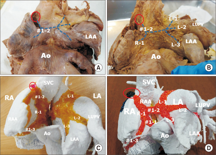 Coronary sinus anatomy showing tributaries and relationship to cardiac chambers