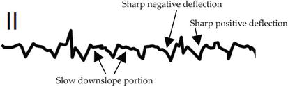 Accessory pathway locations around the AV annuli with delta wave polarity for WPW localization