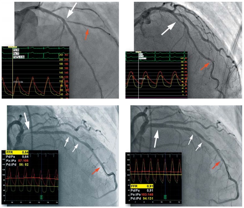 Fractional flow reserve measurement showing pressure tracings and angiographic correlation with stenosis assessment