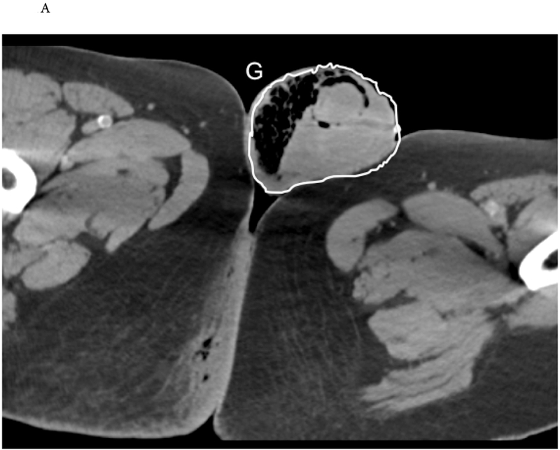 CT imaging of Fournier gangrene showing subcutaneous gas, fascial thickening, and soft tissue inflammation