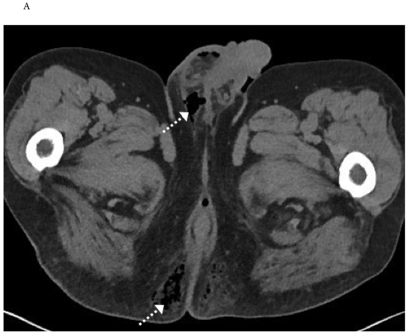CT imaging showing fascial spread pattern of Fournier gangrene beyond visible clinical margins