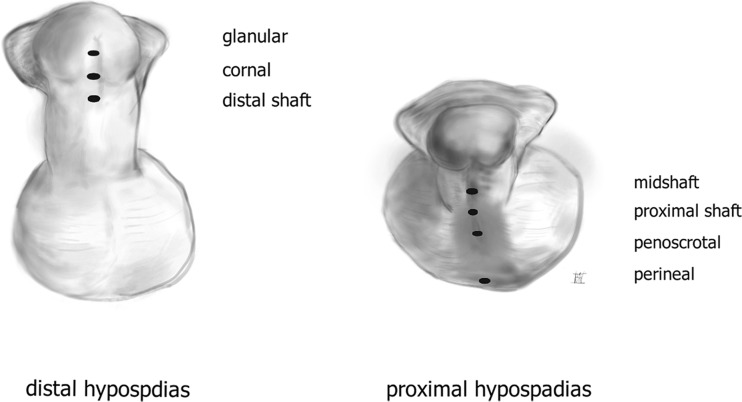 Classification of hypospadias types from distal glanular to proximal perineal positions