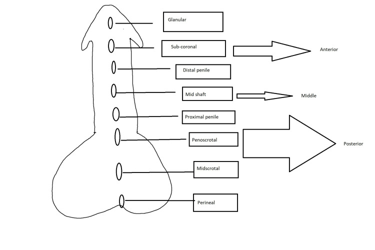 Duckett classification of hypospadias showing meatal positions from glanular to perineal