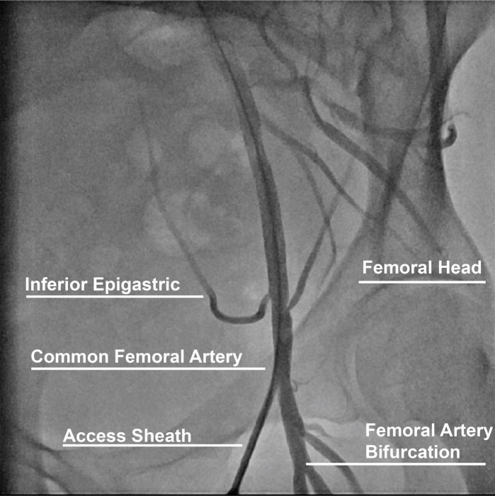 Comparison of transradial and transfemoral arterial access sites for cardiac catheterization