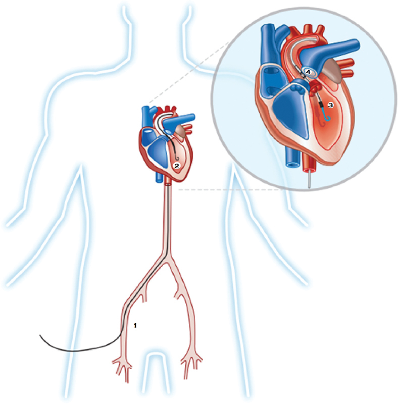 Impella percutaneous ventricular assist device showing catheter positioning across the aortic valve from LV to aorta