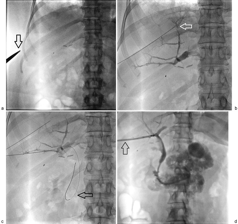 Percutaneous transhepatic biliary drainage showing cholangiogram with catheter crossing biliary obstruction