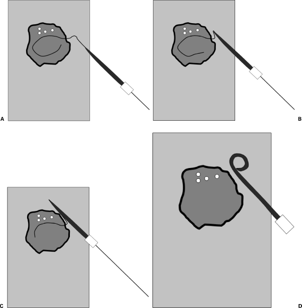 Catheter drainage technique showing proper and improper catheter positions within fluid collections