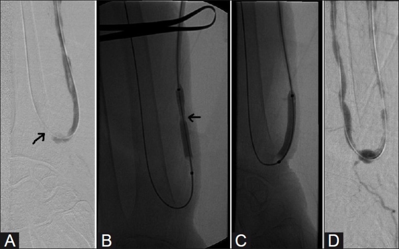 Sequential cutting balloon angioplasty of dialysis access stenosis showing pre-dilation stenosis, balloon inflation, and post-dilation result