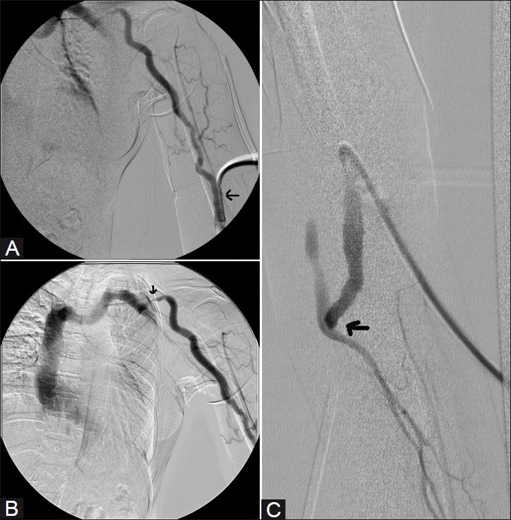 Fistulogram of brachiocephalic arteriovenous fistula demonstrating venous outflow stenosis