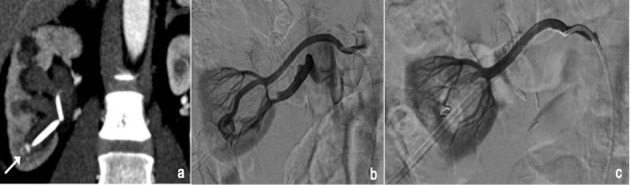 Metallic embolization coils of various sizes and configurations used in transcatheter embolization