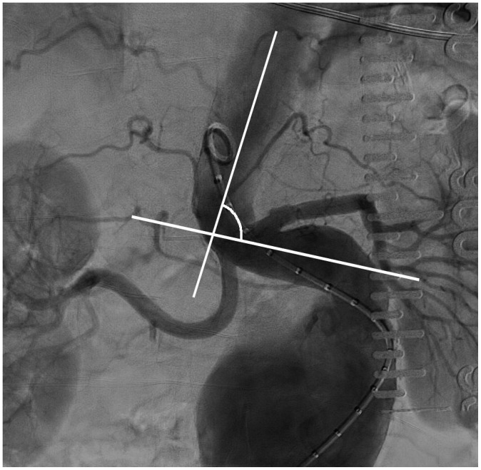 Aortic neck angulation measurement for EVAR planning on CTA reconstruction
