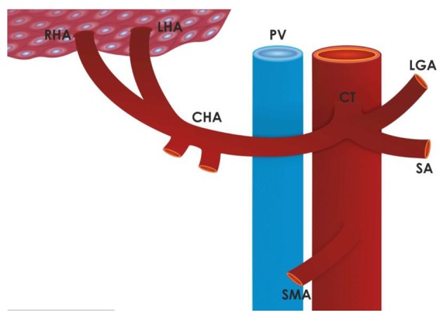 Normal hepatic arterial anatomy Michel Type I showing celiac trunk, common hepatic artery, and proper hepatic artery