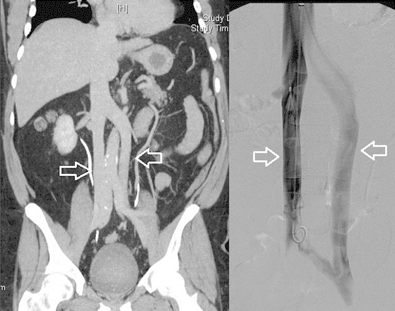 Inferior vena cava anatomy showing renal veins, hepatic veins, and common iliac vein confluence