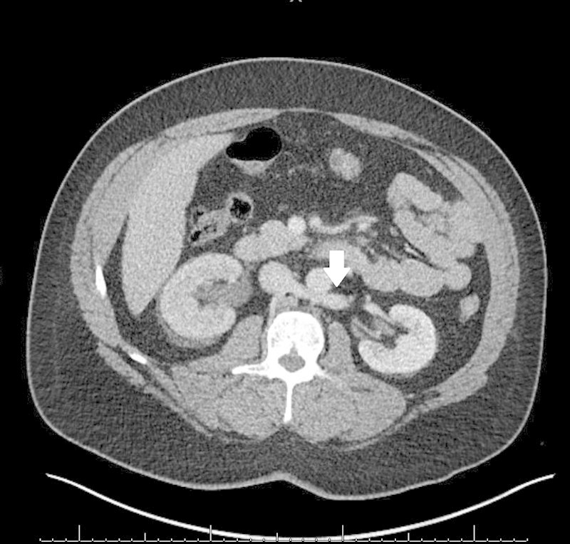 IVC filter placement anatomy showing retroaortic left renal vein variant and filter positioning relative to renal veins