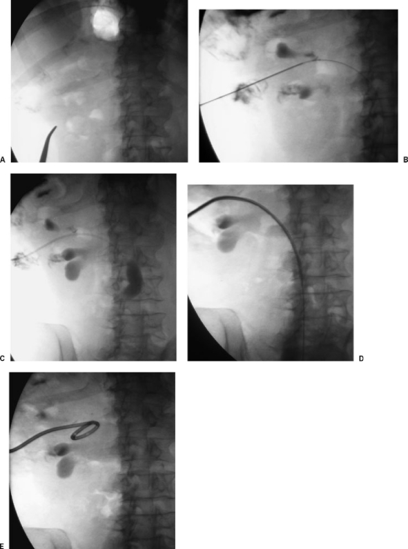 Percutaneous nephrostomy technique showing single-stick approach with needle directed into posterior lower pole calyx