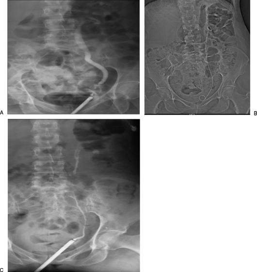 Fluoroscopic images showing antegrade ureteral stent placement through percutaneous nephrostomy access