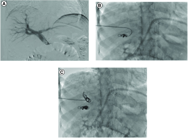 Portal vein embolization technique showing catheter advancement and selective embolization with coils