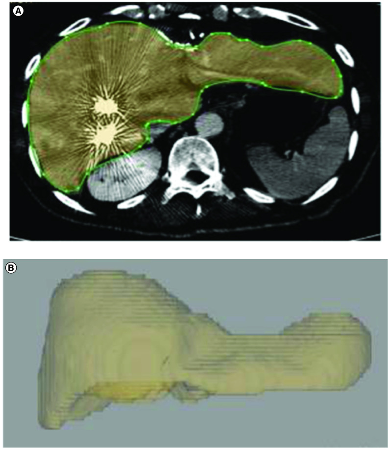 Post-PVE CT volumetry with 3D volume rendering showing future liver remnant hypertrophy and coils in embolized portal branches