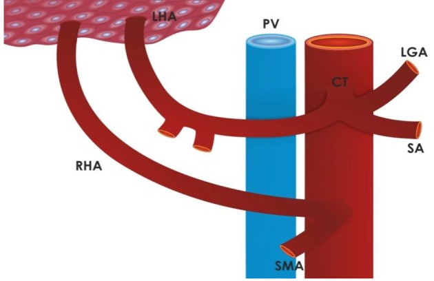 Replaced right hepatic artery arising from the superior mesenteric artery Michel Type III variant