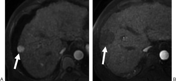 Pre-ablation MRI showing arterially enhancing hepatocellular carcinoma targeted for radiofrequency ablation