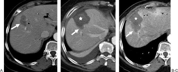 Post-ablation CT showing hypoattenuating ablation zone encompassing the treated tumor with adequate margin