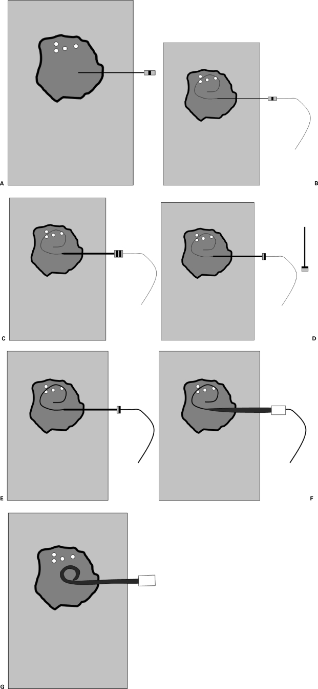 Seldinger technique sequential steps showing needle puncture, guidewire insertion, needle removal, and catheter advancement