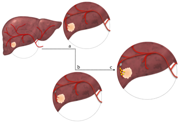 Balloon-occluded TACE technique showing superselective catheterization of tumor-feeding artery with balloon occlusion