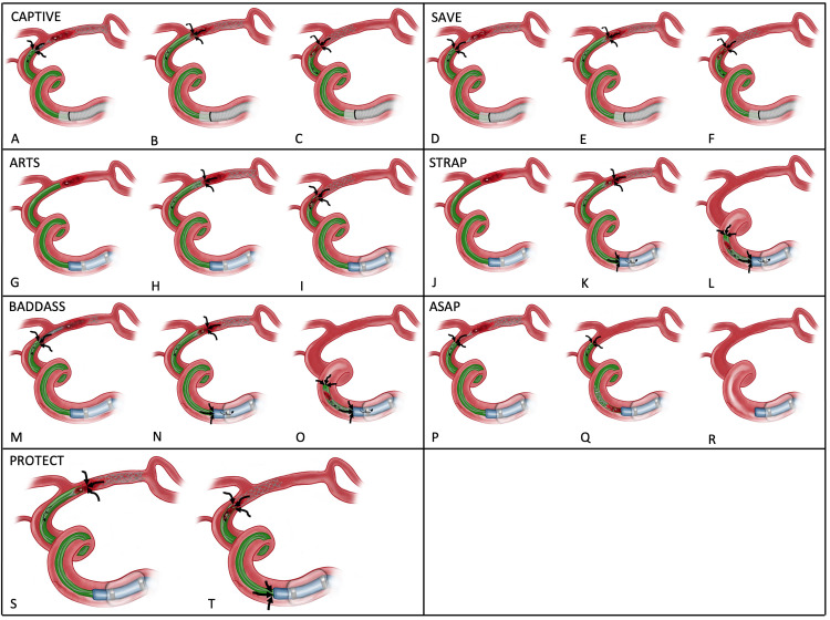 Advanced mechanical thrombectomy techniques for acute ischemic stroke including combined stent retriever and aspiration approaches