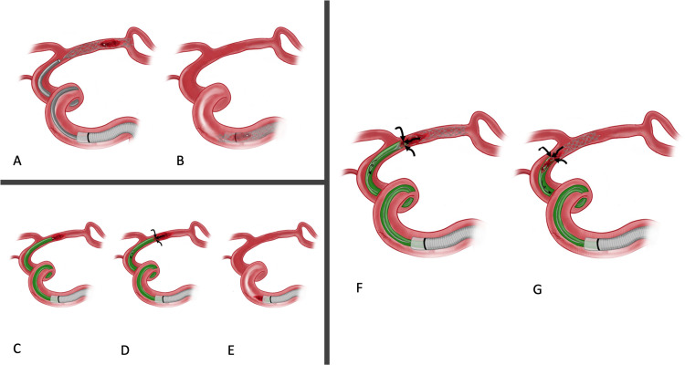 Standard mechanical thrombectomy techniques including stent retriever, aspiration, and combined approaches