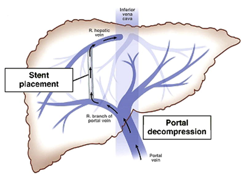 TIPS procedure showing covered stent connecting hepatic vein to portal vein through liver parenchyma