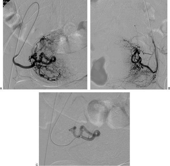 Selective uterine artery angiogram before and after embolization for symptomatic fibroids