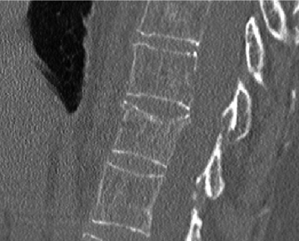 CT image showing transpedicular approach for vertebroplasty with needle positioned in the vertebral body
