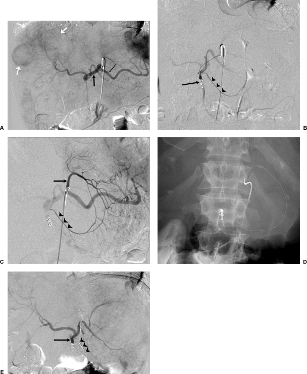 Pre-radioembolization hepatic arteriography showing tumor-feeding vessels and mapping angiogram for Y-90 treatment planning