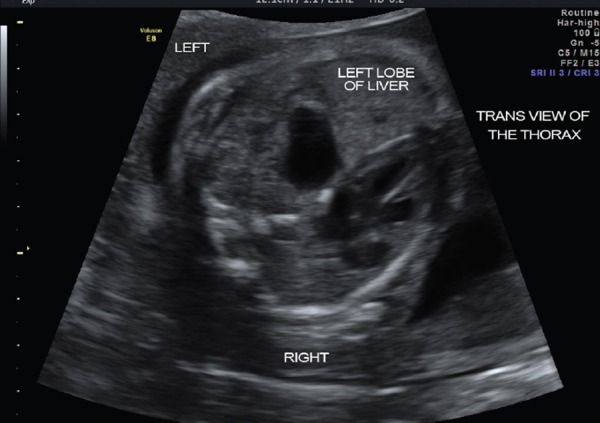 Prenatal ultrasound image of left-sided congenital diaphragmatic hernia showing herniated abdominal contents in fetal thorax
