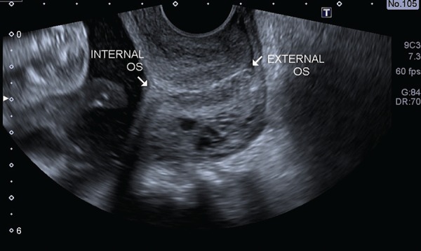 Transvaginal ultrasound image demonstrating cervical length measurement technique