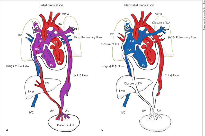 Schematic of normal fetal and neonatal cardiovascular circulation showing the three fetal shunts