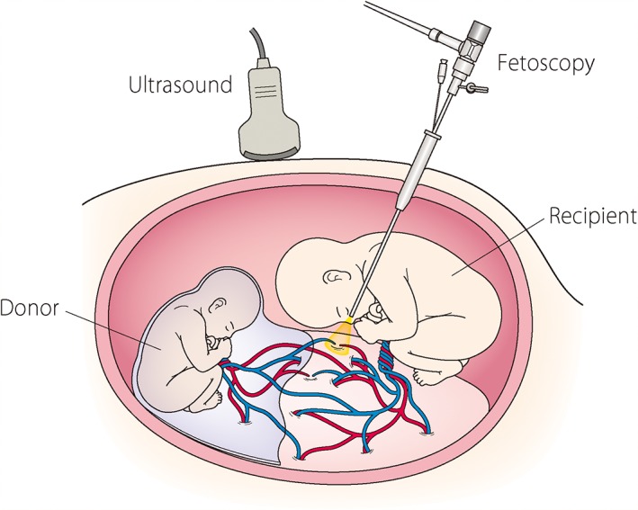 Schematic representation of fetoscopic laser photocoagulation procedure for twin-to-twin transfusion syndrome