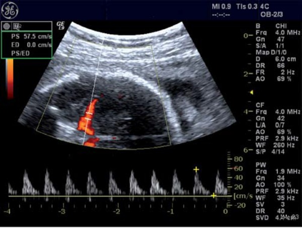 Middle cerebral artery peak systolic velocity Doppler measurement for fetal anemia detection